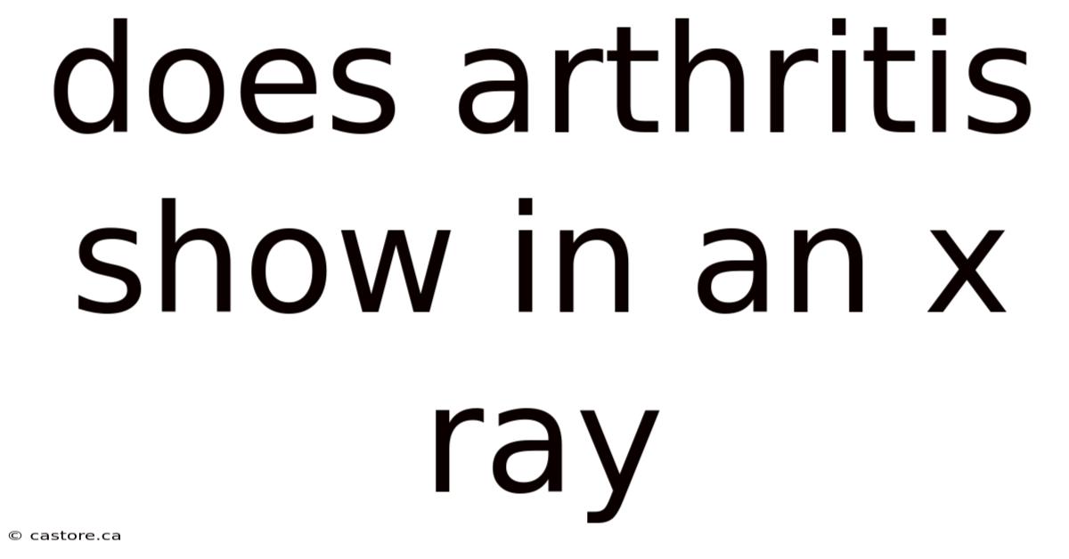 Does Arthritis Show In An X Ray