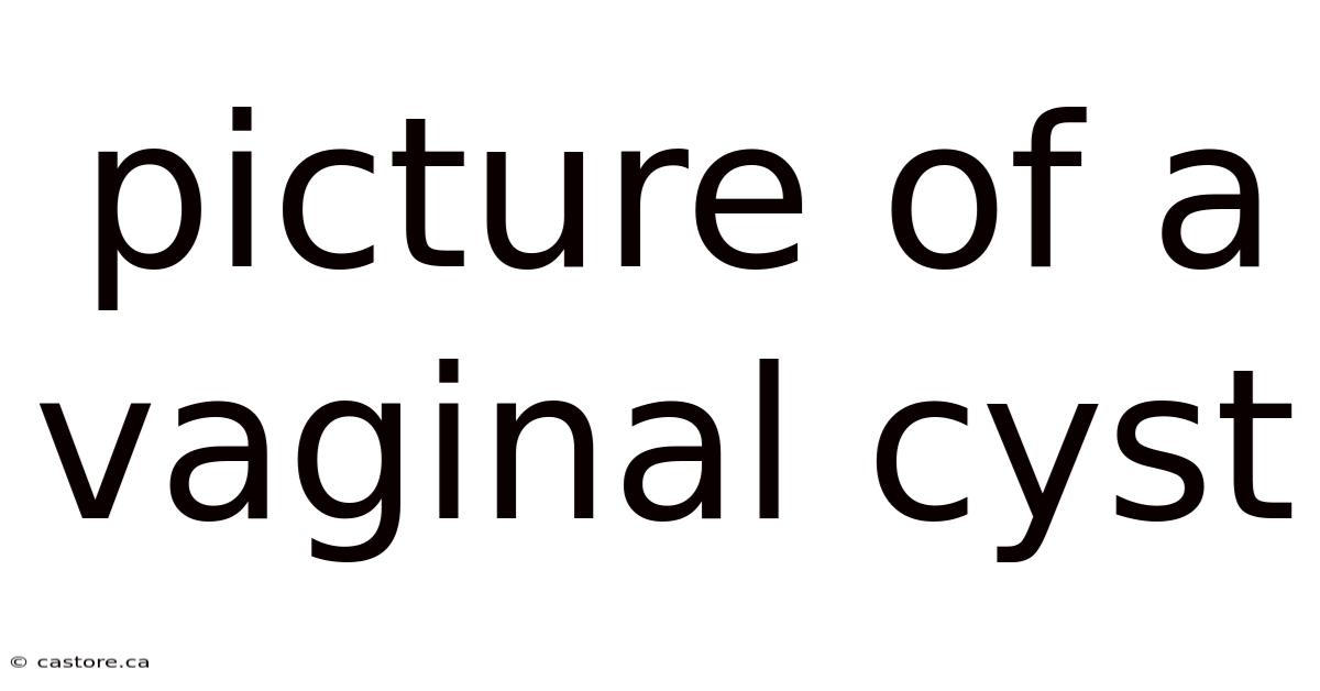 Picture Of A Vaginal Cyst