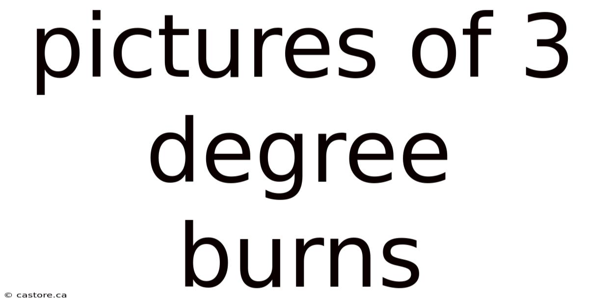 Pictures Of 3 Degree Burns
