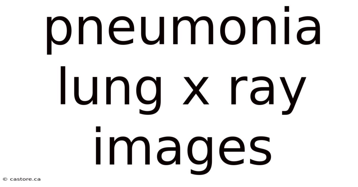 Pneumonia Lung X Ray Images