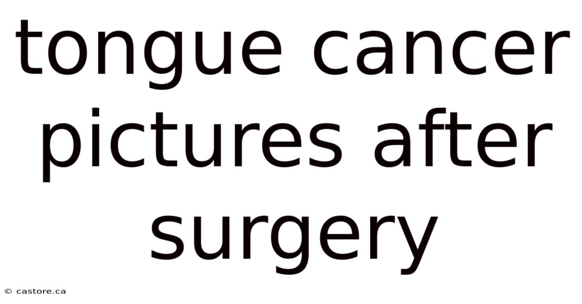 Tongue Cancer Pictures After Surgery
